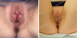 Thẩm mỹ vùng kín DHT Clinic - ca 19