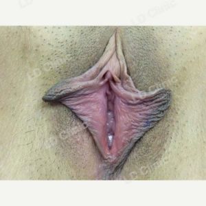 Cắt môi bé DHT Clinic - ca 25