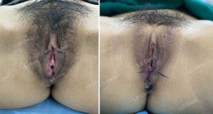 Thẩm mỹ vùng kín DHT Clinic - ca 30