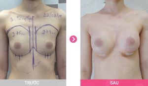 Nâng ngực đặt túi Mentor 275 cc, thẩm mỹ Hồng Ngọc - ca 1