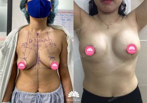 Nâng ngực đặt túi Motiva 265- 285 cc kết hợp treo sa trễ đường quầng - ca 12