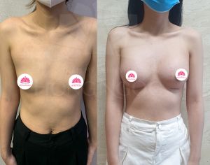Nâng ngực thẩm mỹ Hồng Ngọc - ca 15
