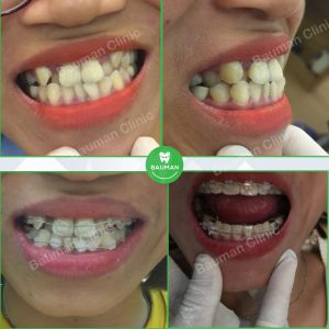 Ca niềng răng số 5065 - Nha khoa Bauman