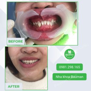 Ca niềng răng số 5066 - Nha khoa Bauman