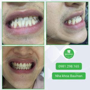 Ca niềng răng số 5077 - Nha khoa Bauman