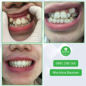Ca niềng răng số 5080 - Nha khoa Bauman