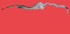 Da mũi mỏng, sống mũi rất thấp (gần như không có) thì phải nâng mũi thế nào?