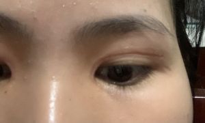 Nhiều nếp mí sau cắt mí