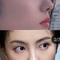 Da mũi mỏng, sống mũi rất thấp (gần như không có) thì phải nâng mũi thế nào?