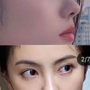 Da mũi mỏng, sống mũi rất thấp (gần như không có) thì phải nâng mũi thế nào?