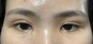Nhiều nếp mí sau cắt mí