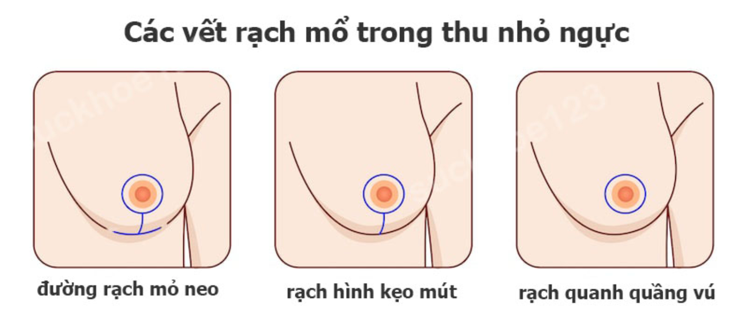 Các đường rạch thu nhỏ ngực - 2