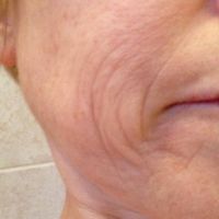 Vùng mặt dưới của tôi bị chảy xệ và nhăn nheo, phương pháp nào điều trị vấn đề này tốt nhất và tôi có nên ra nước ngoài không?