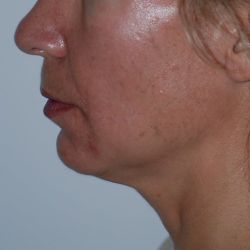Cách tốt nhất để điều trị má xệ, rãnh cười sâu và dải thừng cổ là gì?