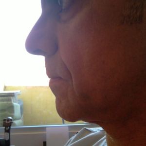 Tôi nên xử lý mặt chảy xệ ở tuổi 48 như thế nào?