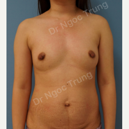 Combo ngực bụng Dr Ngọc Trung - ca 1