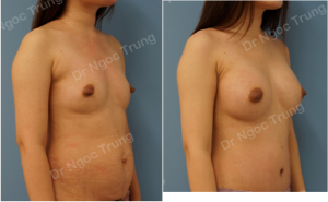 Combo ngực bụng Dr Ngọc Trung - ca 1