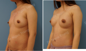Combo ngực bụng Dr Ngọc Trung - ca 1