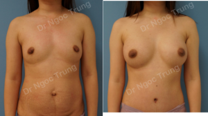 Combo ngực bụng Dr Ngọc Trung - ca 1