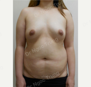 Combo ngực bụng Dr Ngọc Trung - ca 3