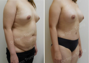 Combo ngực bụng Dr Ngọc Trung - ca 3