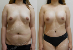 Combo ngực bụng Dr Ngọc Trung - ca 3