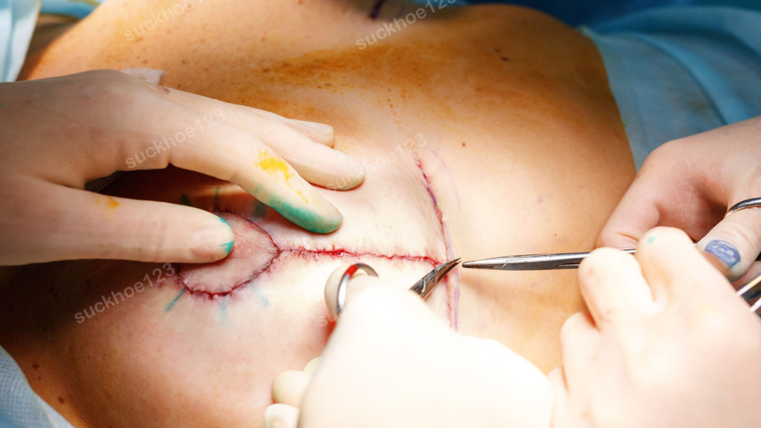 Vết mổ thu nhỏ ngực bị tách miệng sau phẫu thuật