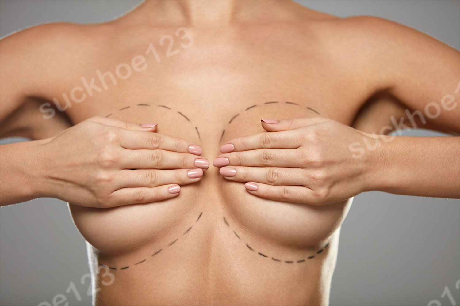 Các đường rạch mổ trong thu nhỏ ngực và vết sẹo sau phẫu thuật