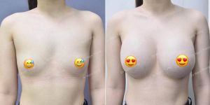 Nâng ngực Dr Ngọc Trung - ca 1