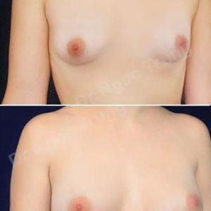 Nâng ngực Dr Ngọc Trung - ca 33