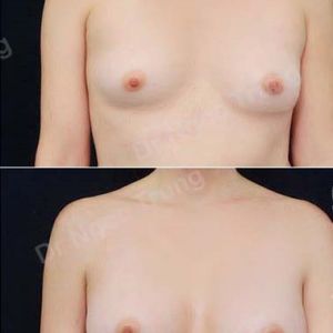 Nâng ngực Dr Ngọc Trung - ca 37