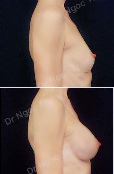 Nâng ngực Dr Ngọc Trung - ca 44