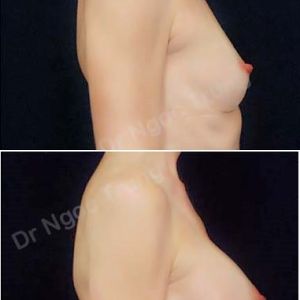 Nâng ngực Dr Ngọc Trung - ca 44