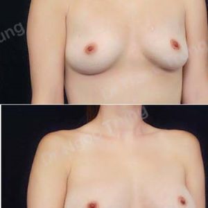 Nâng ngực Dr Ngọc Trung - ca 45