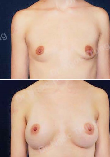 Nâng ngực Dr Ngọc Trung - ca 46