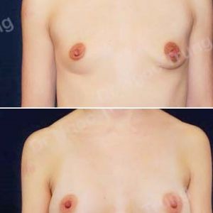 Nâng ngực Dr Ngọc Trung - ca 46