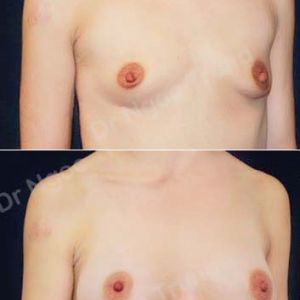 Nâng ngực Dr Ngọc Trung - ca 46