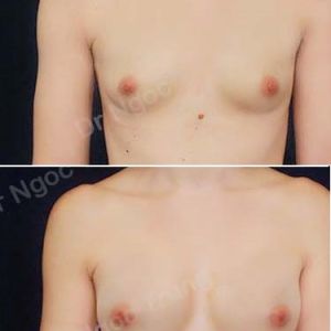 Nâng ngực Dr Ngọc Trung - ca 51