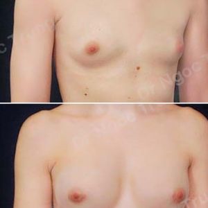 Nâng ngực Dr Ngọc Trung - ca 51