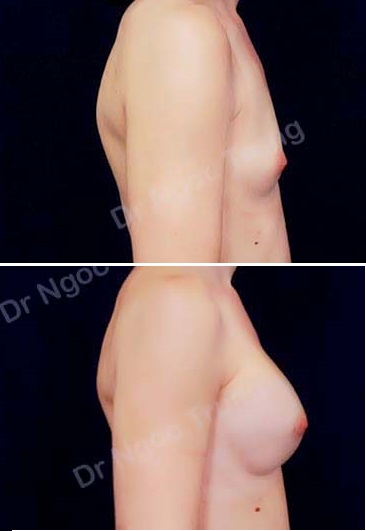 Nâng ngực Dr Ngọc Trung - ca 51