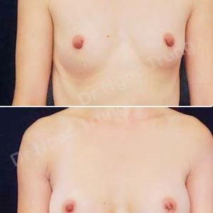 Nâng ngực Dr Ngọc Trung - ca 54