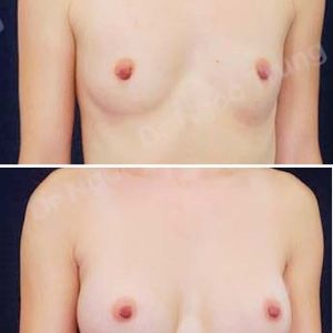 Nâng ngực Dr Ngọc Trung - ca 54