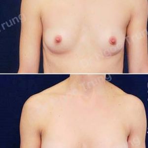 Nâng ngực Dr Ngọc Trung - ca 55