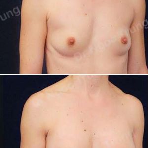 Nâng ngực Dr Ngọc Trung - ca 55