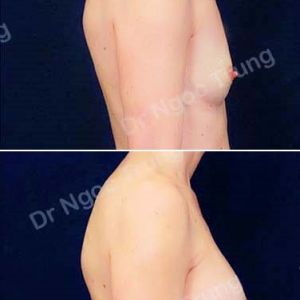 Nâng ngực Dr Ngọc Trung - ca 55