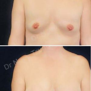 Nâng ngực Dr Ngọc Trung - ca 56