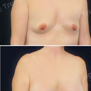 Nâng ngực Dr Ngọc Trung - ca 56