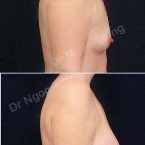 Nâng ngực Dr Ngọc Trung - ca 56
