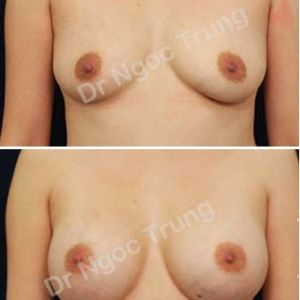 Nâng ngực Dr Ngọc Trung - ca 57