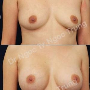 Nâng ngực Dr Ngọc Trung - ca 57